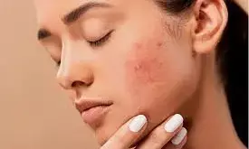 मेडिकल में बढ़ी त्वचा विकार के मरीजों की संख्या