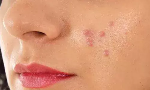 क्या आप भी गर्मी में चेहरे पर मुहांसों से हैं परेशान? इन आसान उपायों से मिलेगी राहत