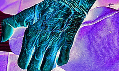 नागपुर जिले में हर माह मिल रहे कुष्ठरोग के 160 मरीज नागपुर जिले में हर माह मिल रहे कुष्ठरोग के 160 मरीज