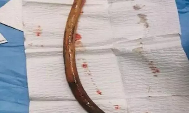 शख्स ने निगला एक फीट लंबा डंडा, बाहर निकालने में डॉक्टरों को याद आई नानी, जानें पूरा वाक्या