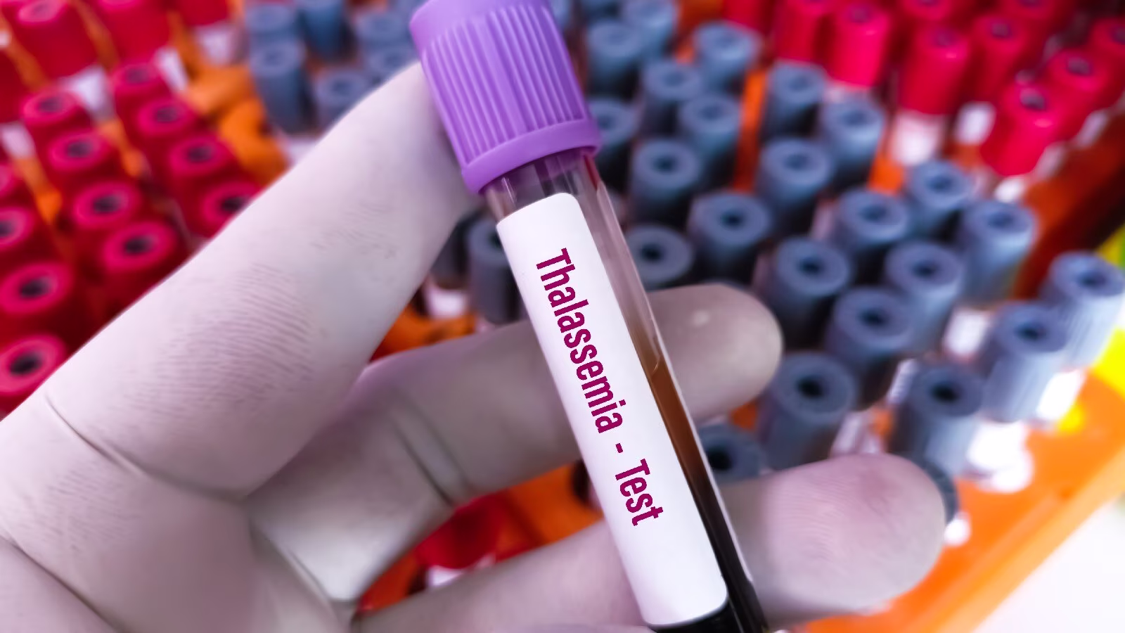 मुश्किल में थैलेसीमिया पीड़ित - 1.42 करोड़ की डेफ्रॉसिरॉक्स 1000 लोगों के लिए आफत मुश्किल में थैलेसीमिया पीड़ित - 1.42 करोड़ की डेफ्रॉसिरॉक्स 1000 लोगों के लिए आफत