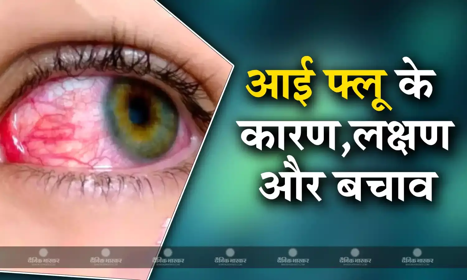 बारिश के मौसम में बढ़ रहा है आई फ्लू का खतरा, जानिए क्या हैं इसके कारण, लक्षण और बचाव