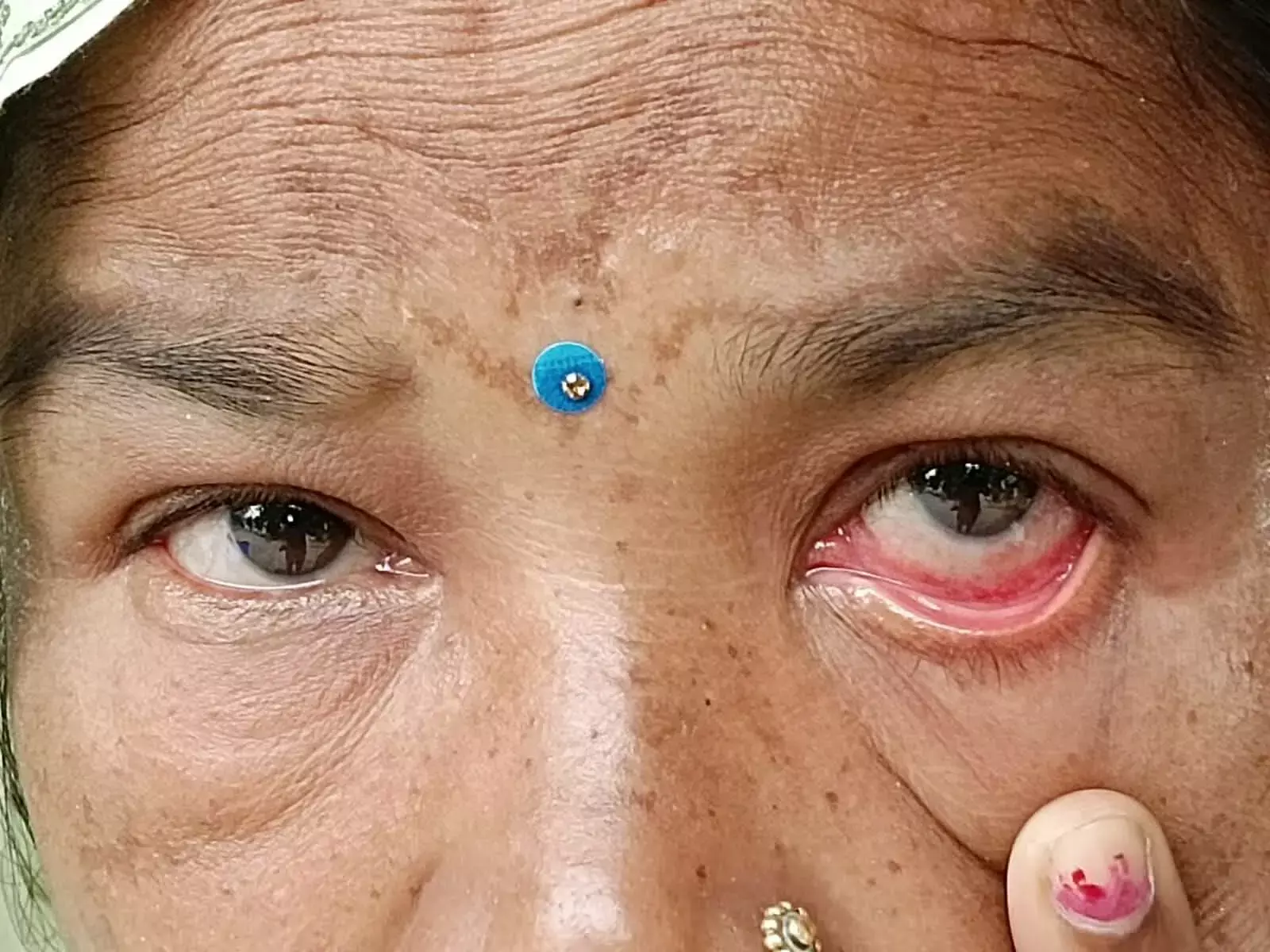 रेड आई / वायरल कंजेक्टिवाइटिस / आई फ्लू  कारण, लक्षण एवं बचाव -  डॉ भावना राय पटेल