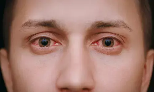 उत्तराखंड में आई फ्लू को लेकर स्वास्थ्य सचिव ने जारी की गाइडलाइन, दिए आवश्यक निर्देश