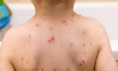 खसरे से महाराष्ट्र में सबसे ज्यादा बच्चों की मृत्यु