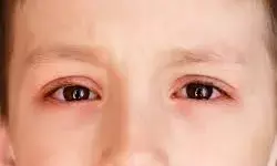 बच्चों में फैल रहा नेत्र संक्रमण, चिंता से घिरे अभिभावक