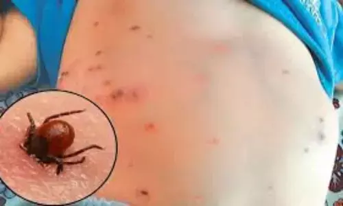 नियंत्रित है स्क्रब टाइफस, बीते साल के मुकाबले इस साल मरीजों की संख्या में भारी गिरावट नियंत्रित है स्क्रब टाइफस, बीते साल के मुकाबले इस साल मरीजों की संख्या में भारी गिरावट