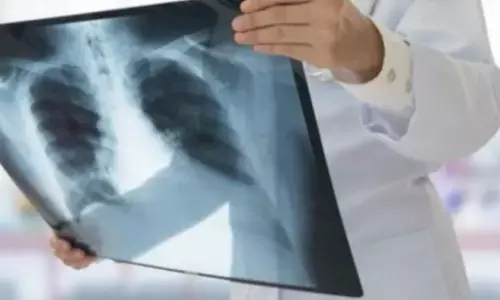 4 साल में टीबी से 1456 लोगों की मौत, 21,895 एक्टिव मरीज