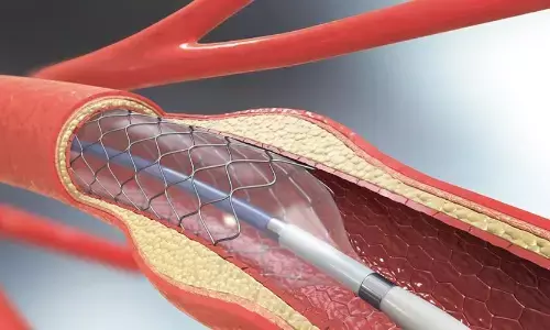 मिरस तकनीक से दूर होगा हार्ट ब्लॉकेज, दवा की जरूरत होगी कम मिरस तकनीक से दूर होगा हार्ट ब्लॉकेज, दवा की जरूरत होगी कम