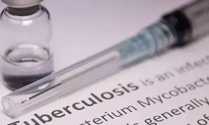 2022 में वैश्विक स्तर पर रिकॉर्ड 7.5 मिलियन लोगों में टीबी का पता चला 2022 में वैश्विक स्तर पर रिकॉर्ड 7.5 मिलियन लोगों में टीबी का पता चला