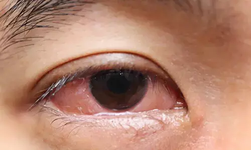 पटाखे रोशनी छीन लेते हैं, हो सकती त्वचा की बीमारियां और बहरापन पटाखे रोशनी छीन लेते हैं, हो सकती त्वचा की बीमारियां और बहरापन