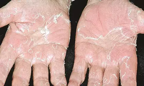 त्वचा रोग विभाग में 25 फीसदी मरीज ठंड के शिकार त्वचा रोग विभाग में 25 फीसदी मरीज ठंड के शिकार