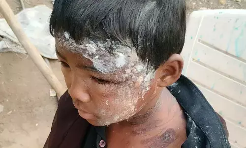 आश्रमशाला का बच्चा खौलते पानी से झुलसा आश्रमशाला का बच्चा खौलते पानी से झुलसा