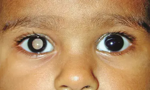 8 साल तक बच्चों की छिन रही आंखों की रोशनी, ग्रामीण क्षेत्र के बच्चे ज्यादा प्रभावित 8 साल तक बच्चों की छिन रही आंखों की रोशनी, ग्रामीण क्षेत्र के बच्चे ज्यादा प्रभावित