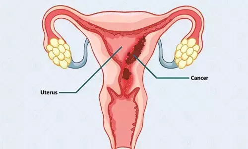 मृत महिलाओं में 19 फीसदी की उम्र 50 से कम, टीकाकरण नीति में HPV शामिल करना जरूरी