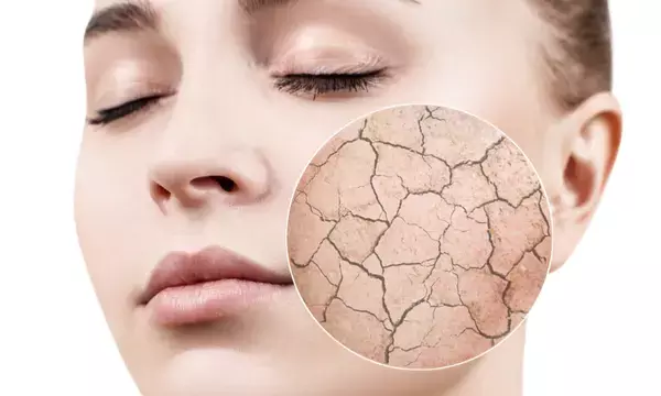 सर्दियों में त्वचा का ख्याल रखने के लिए करें ये 5 काम, रूखापन होगा कम