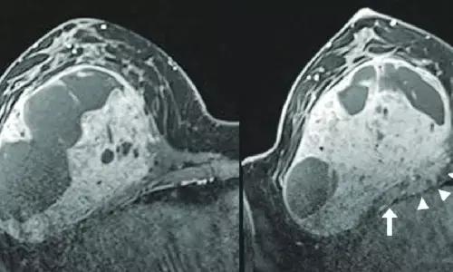 हड्डियों के आसपास कोमल ऊतकों को प्रभावित करता है इविंग सारकोमा कैंसर