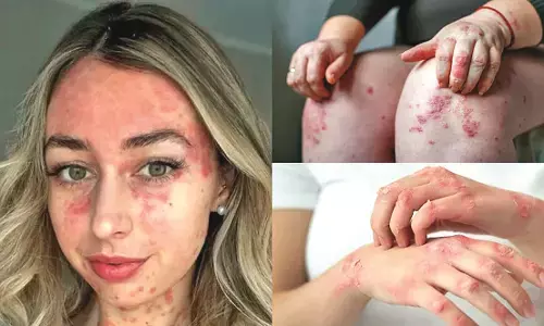 बड़ों के साथ बच्चों को भी घेरने लगा है सोरायसिस, अस्पताल में मरीजों की संख्या बढ़ी बड़ों के साथ बच्चों को भी घेरने लगा है सोरायसिस, अस्पताल में मरीजों की संख्या बढ़ी