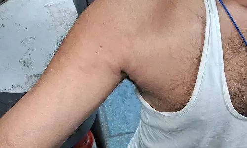 गोंडवाना एक्सप्रेस में खटमलों ने इतना परेशान किया कि करवटें बदलते गुजरी पूरी रात गोंडवाना एक्सप्रेस में खटमलों ने इतना परेशान किया कि करवटें बदलते गुजरी पूरी रात