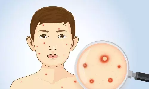 चिकन पॉक्स के मरीज बढ़े, सरकारी अस्पतालों में रोज 10 व निजी में 4 मरीज चिकन पॉक्स के मरीज बढ़े, सरकारी अस्पतालों में रोज 10 व निजी में 4 मरीज