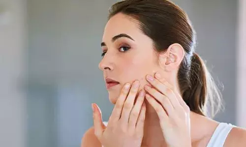 आप भी गर्मी में चेहरे पर होने वाले मुहांसों से हैं परेशान? इन आसान उपायों से मिलेगी राहत