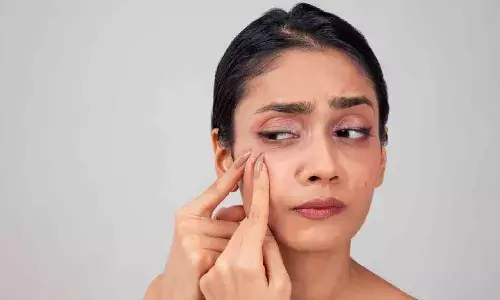 गर्मीयों में पिंपल्स से हैं परेशान तो, ये घरेलू नुस्खे दिलाएंगे इस समस्या से छुटकारा