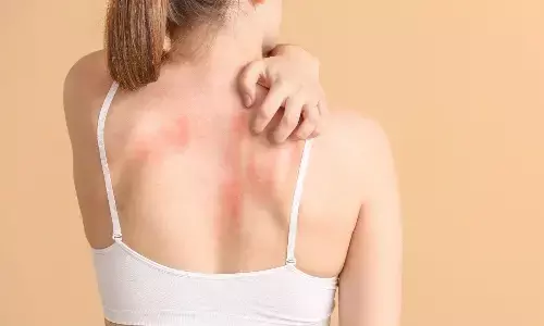 चिलचिलाती गर्मी में घमौरियों से हैं परेशान? अपनाएं ये घरेलू नुस्खे जल्द मिलेगा आराम चिलचिलाती गर्मी में घमौरियों से हैं परेशान? अपनाएं ये घरेलू नुस्खे जल्द मिलेगा आराम