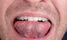 सबसे अधिक हैं मुख कैंसर के मरीज , 68% को तंबाकू चबाने से हुई है बीमारी