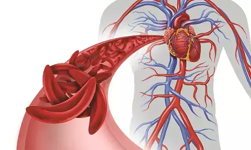 सिकलसेल पीड़ितों काे एकाकी जीवन जीने की नौबत, सालाना 17 तलाक, 735 की शादी नहीं