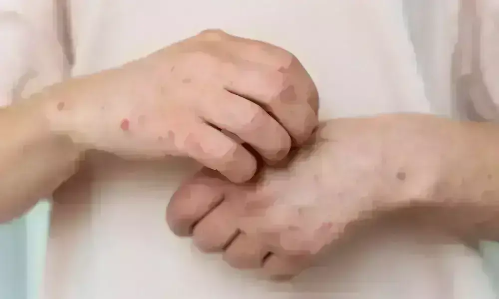 चिकन गुनिया के 118 डेंगू के 51 पॉजिटिव, 837 संदिग्धों की जांच, स्वास्थ्य विभाग की पुष्टि