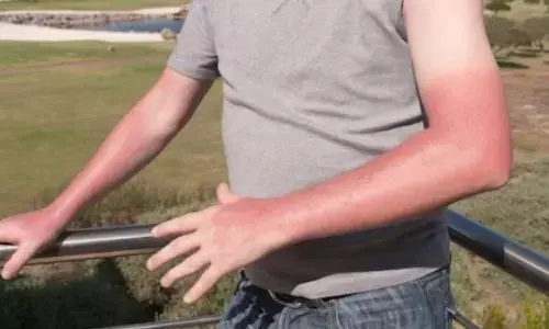 सनबर्न के चलते युवक गया अस्पताल, डॉक्टर्स ने करी सर्जरी, हुई 25 मिनट के लिए मौत!