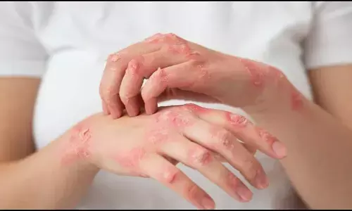 महाराष्ट्र के 59 फीसदी गांवों में कुष्ठ रोग का एक भी मरीज नहीं, शून्य का लक्ष्य