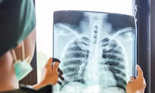 कैसे पूरा होगा मुंबई को 2025 में टीबी मुक्त बनाने का लक्ष्य, साढ़े तीन साल में अस्पताल से भागे 83 मरीज