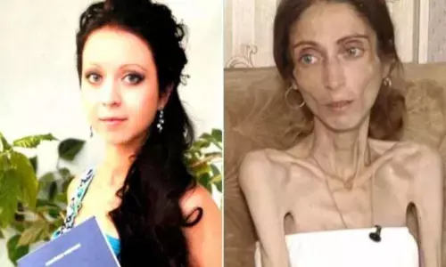 पति हुआ फूले गाल से परेशान, तो पत्नी बन गई कंकाल पति हुआ फूले गाल से परेशान, तो पत्नी बन गई कंकाल