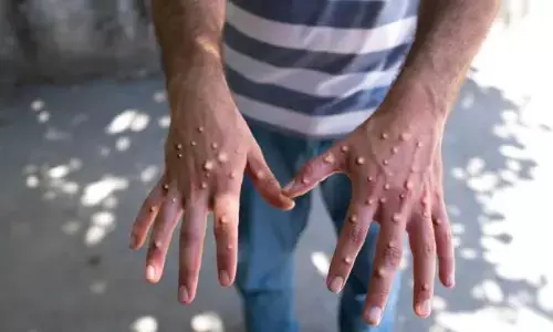 WHO ने किया Mpox को पब्लिक हेल्थ इमरजेंसी घोषित, ये लक्षण दिखाई दें तो लें डॉक्टर की सलाह