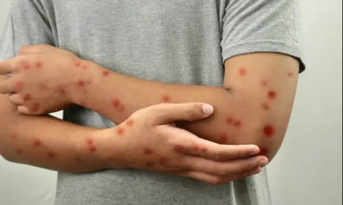 मंकीपॉक्स की नई वैकसीन की WHO की हरी झंडी, अफ्रीका में जल्द शुरू होगा टीकाकरण अभियान