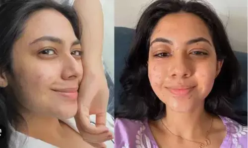 टलाफ्टर शेफ्स के सेट पर खाना बनाते समय रीम शेख के साथ हुआ हादसा, एक्ट्रेस का जला चेहरा, जाने हेल्थ अपडेट