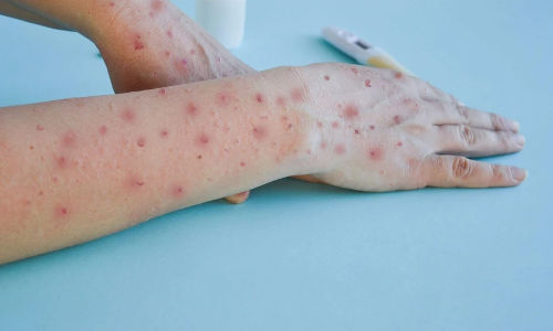 देश में मंकीपॉक्स क्लेड-1 वेरिएंट का पहला मामला, डब्लूएचओ ने घोषित की वर्ल्ड इमरजेंसी