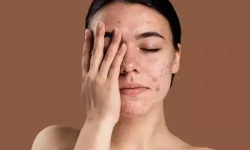 हर खास मौके से पहले निकल आते हैं पिंपल्स, तो ऐसे करें एक ही रात में दूर, करें इन घरेलू उपायों का उपयोग, सुबह तक मिल जाएगी राहत