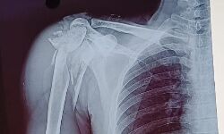 Chhindwara News: सिम्स में सफल ऑपरेशन, मरीज के कंधे की बुरी तरह चूरा हड्डियों को दोबारा जोड़ा Chhindwara News: सिम्स में सफल ऑपरेशन, मरीज के कंधे की बुरी तरह चूरा हड्डियों को दोबारा जोड़ा