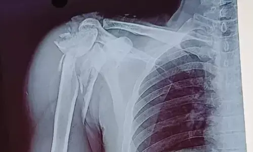 सिम्स में सफल ऑपरेशन, मरीज के कंधे की बुरी तरह चूरा हड्डियों को दोबारा जोड़ा सिम्स में सफल ऑपरेशन, मरीज के कंधे की बुरी तरह चूरा हड्डियों को दोबारा जोड़ा