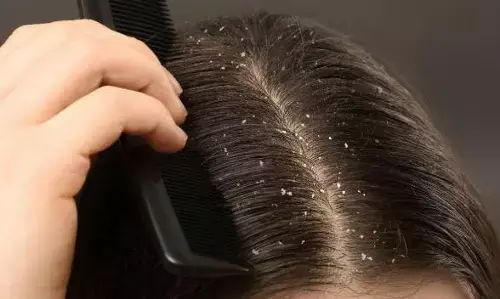 अगर आप भी हैं डैंड्रफ से परेशान, तो अपनाएं इन घरेलू टिप्स को, डैंड्रफ रुकेगा और मिलेगा साफ सुथरा स्कैल्प अगर आप भी हैं डैंड्रफ से परेशान, तो अपनाएं इन घरेलू टिप्स को, डैंड्रफ रुकेगा और मिलेगा साफ सुथरा स्कैल्प