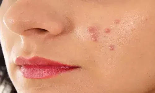 अगर आप भी हैं मुंहासे से परेशान, तो फॉलो करें ये टिप्स, पिंपल्स से जल्द मिलेगा छुटकारा