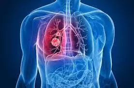 अब पॉलीक्लीनिक-प्रसूतिगृह में होगी ओरल, स्तन और गर्भाशय कैंसर की जांच अब पॉलीक्लीनिक-प्रसूतिगृह में होगी ओरल, स्तन और गर्भाशय कैंसर की जांच