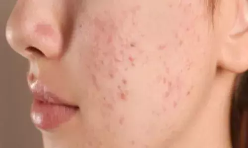 अगर आप भी हैं पिंपल्स से परेशान, तो इन चीजों को करने से बचें, कुछ ही दिन में चेहरा दिखेगा प्यारा-प्यारा अगर आप भी हैं पिंपल्स से परेशान, तो इन चीजों को करने से बचें, कुछ ही दिन में चेहरा दिखेगा प्यारा-प्यारा