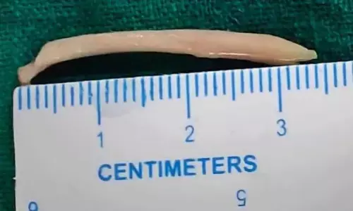 बिरयानी बनी बला - गले में फंसी चिकन की हड्डी नाक के पिछले हिस्से से निकली