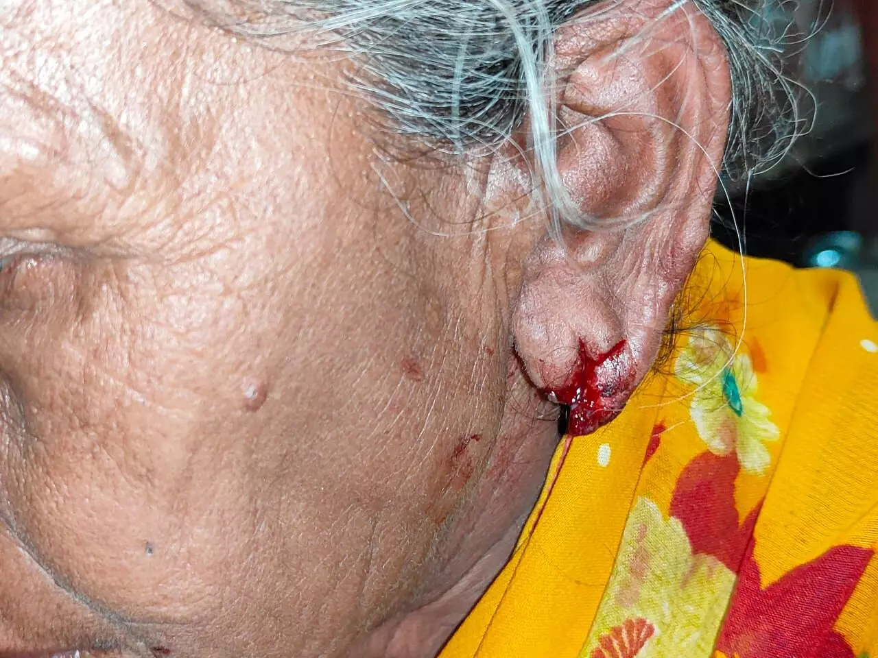 झपटा मारकर बुजुर्ग महिला के काने से सोने की बाली छिनी, घायल कर फरार हुए आरोपी झपटा मारकर बुजुर्ग महिला के काने से सोने की बाली छिनी, घायल कर फरार हुए आरोपी