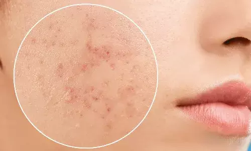 चिपचिपे चेहरे से पाना चाहते हैं छुटकारा तो घर पर जरूर बनाएं ये मास्क, मुहासे भी होंगे कम