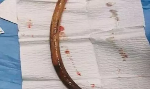 शख्स ने निगला एक फीट लंबा डंडा, बाहर निकालने में डॉक्टरों के छूटे पसीने, जानें क्या है मामला शख्स ने निगला एक फीट लंबा डंडा, बाहर निकालने में डॉक्टरों के छूटे पसीने, जानें क्या है मामला