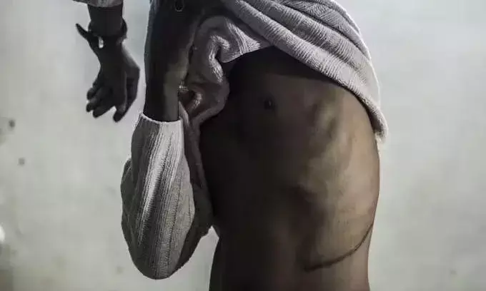 वन किडनी विलेज के नाम से कुख्यात हो चुका बांग्लादेश का यह गांव, भारत आकर किडनी बेच रहे लोग